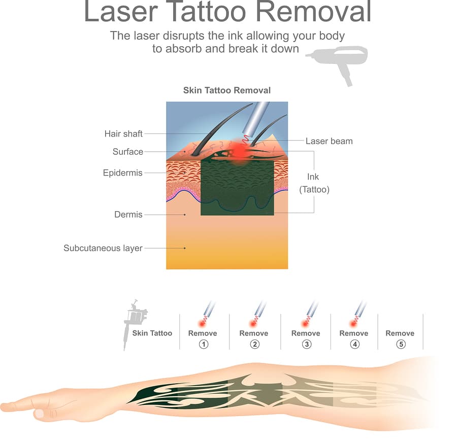 Tattoo removal image demonstrating the laser beams targeting the tattoo ink with a visual of an arm showing the fading of tattoo across 5 treatments