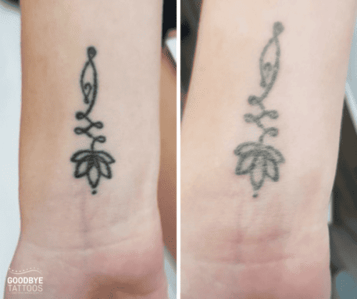 Laser tattoo removal less pain no redness, tattoo will fade. Without  scarring