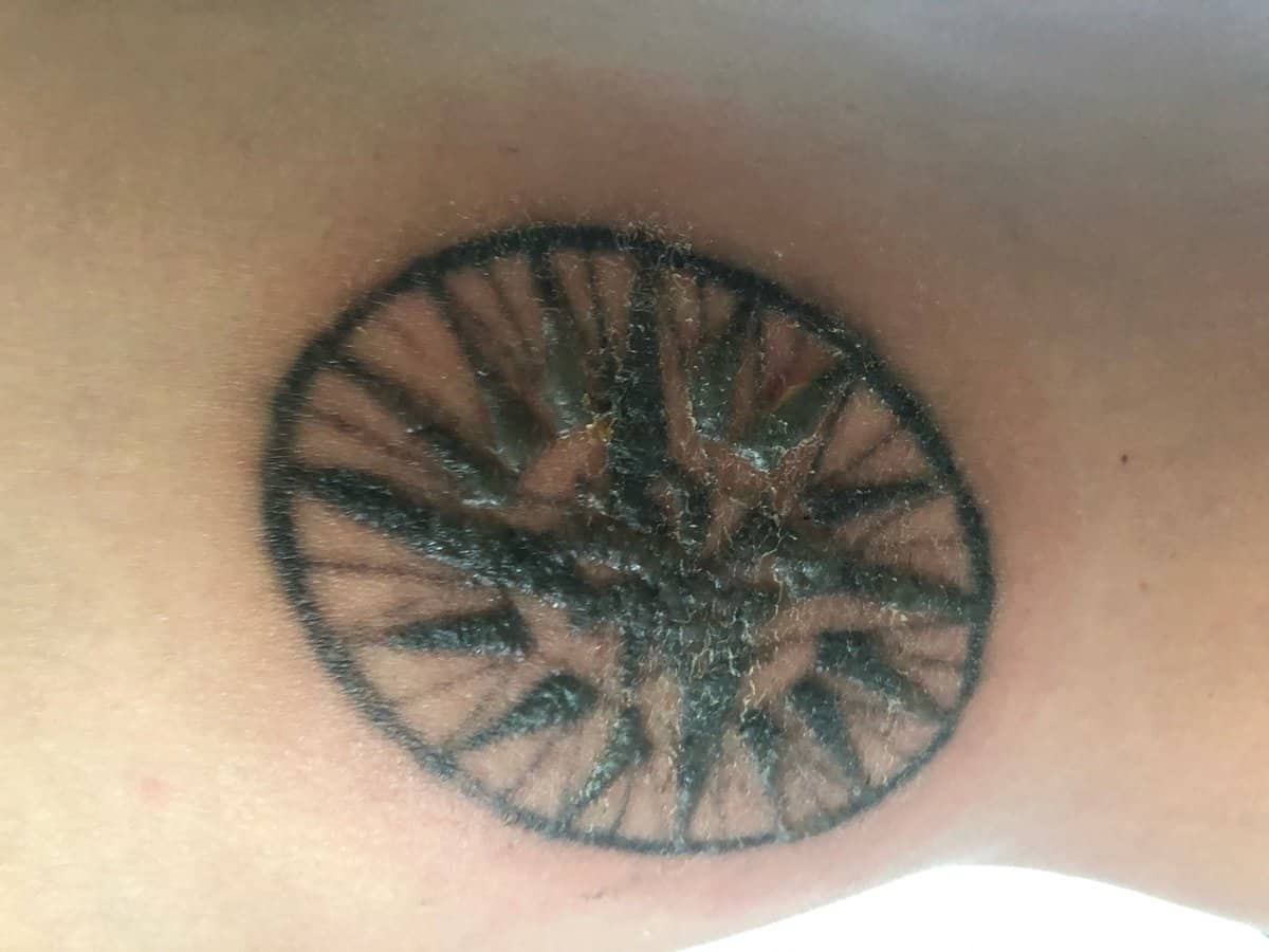 Laser tattoo removal aftercare Goodbye Tattoos