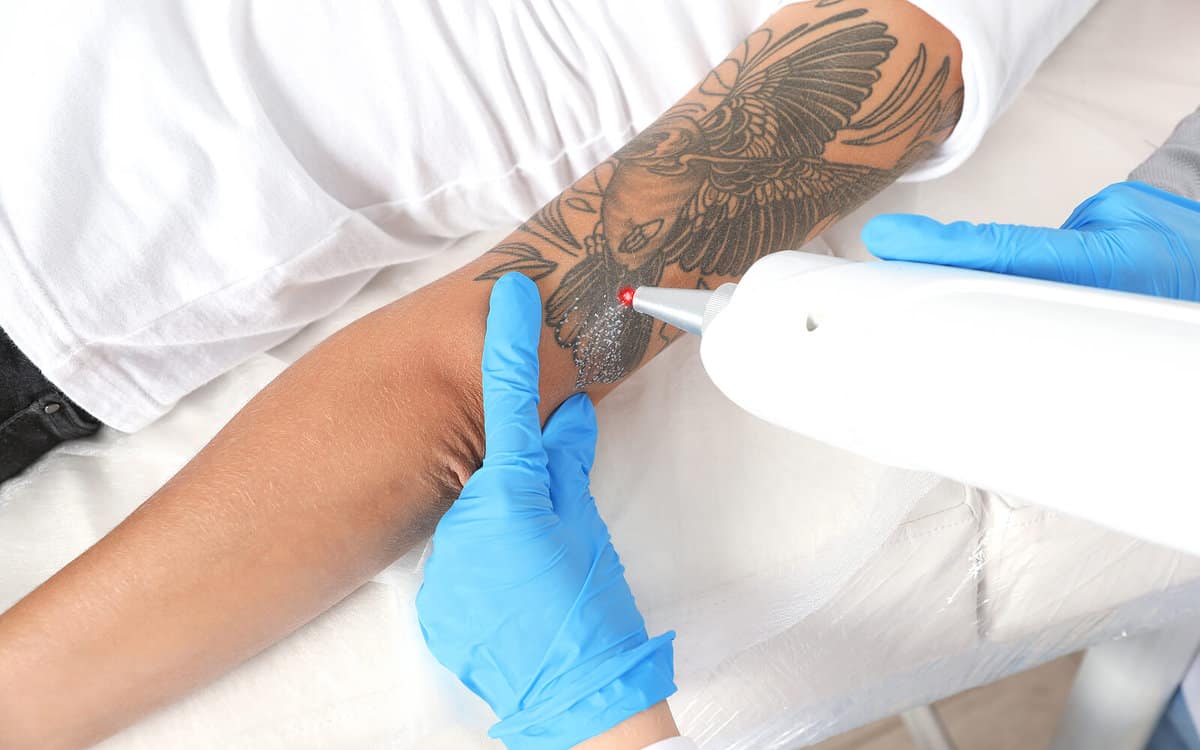 Laser tattoo removal treatment on a woman with a tattoo on her arm