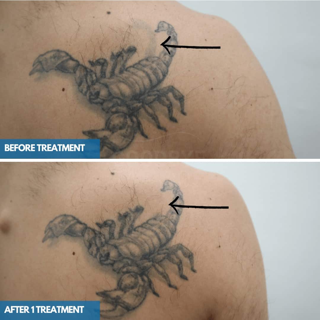 Client-progress-photos-back-shading showing a scorpion tattoo before and after one treatment of tattoo removal.