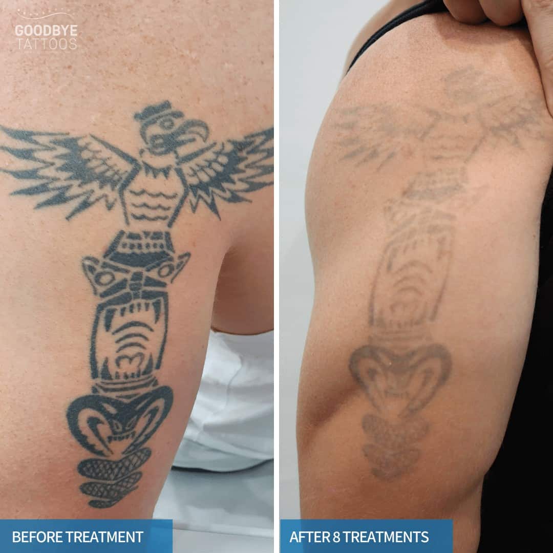 Tattoo Removal Before and After Goodbye Tattoos