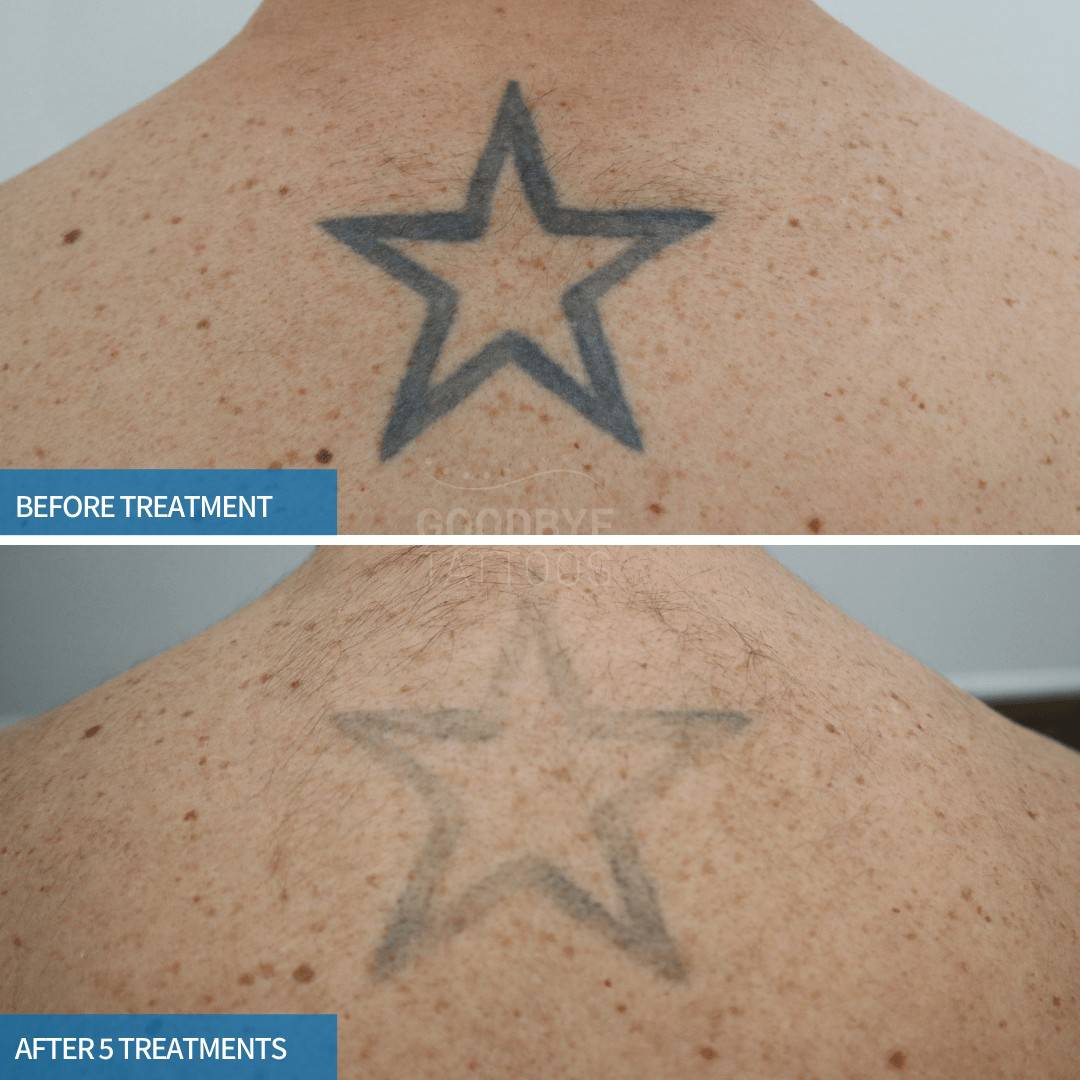 Star tattoo fading
