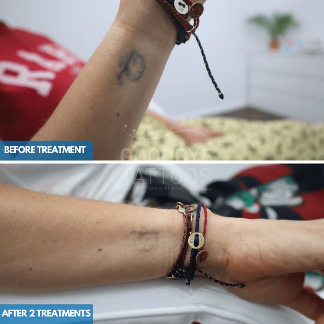 Tattoo fading results