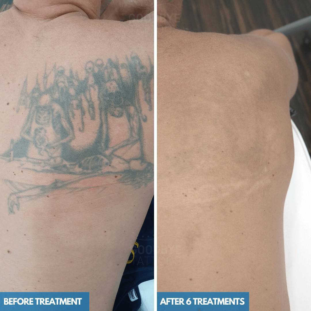 Tattoo fading results