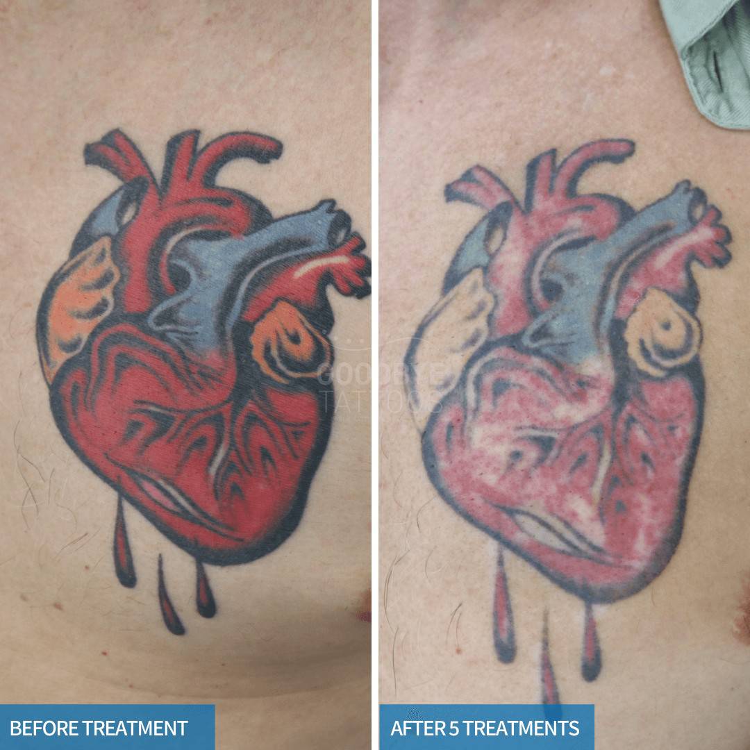 Laser tattoo removal progress photo of the red, orange, and blue tattoo of a human heart.