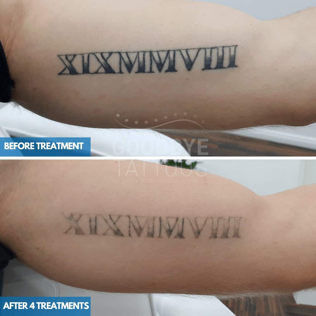 Laser tattoo removal progress photo of the Roman numerals in black ink on the inner arm.