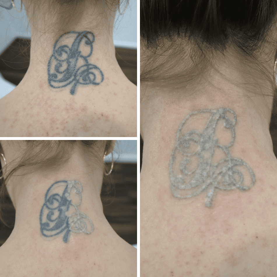 Tattoo removal frosting effect on the neck after laser treatment