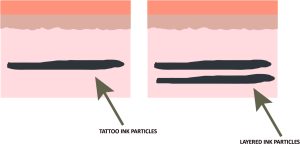 laser tattoo removal Image showing what a layered tattoo looks like