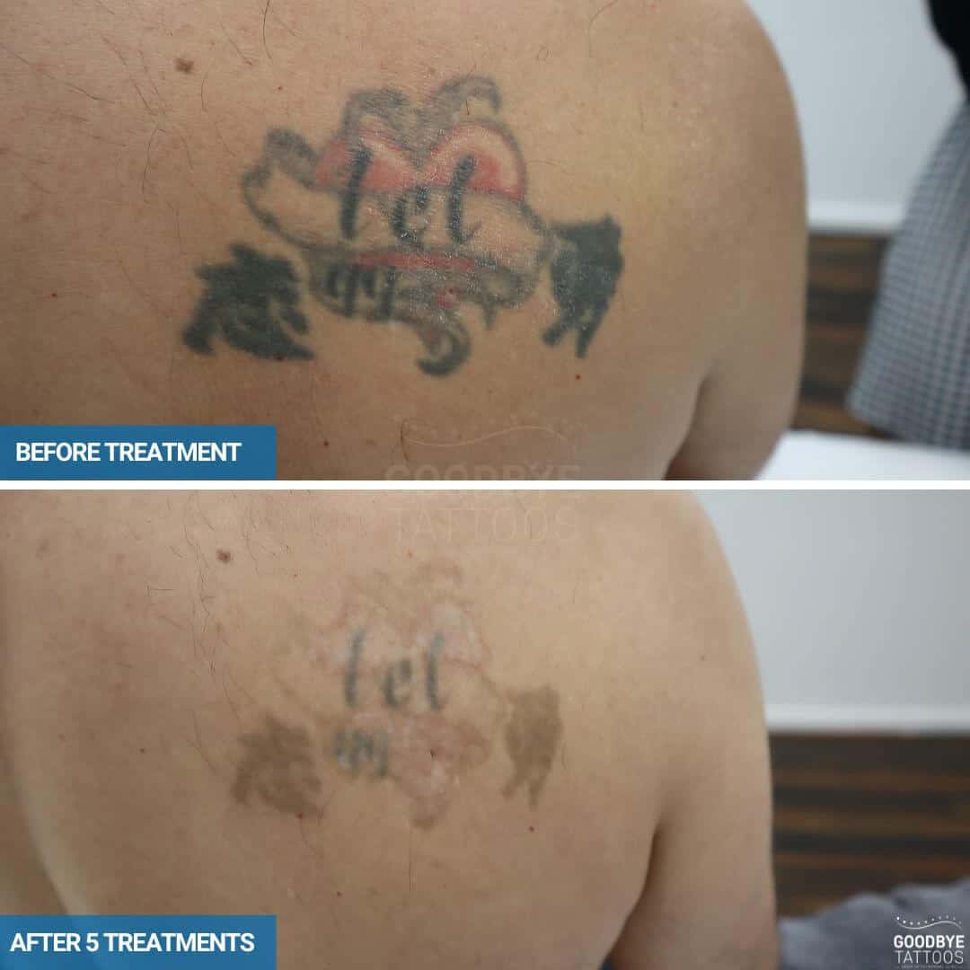 Laser tattoo removal of a black and red tattoo on the back