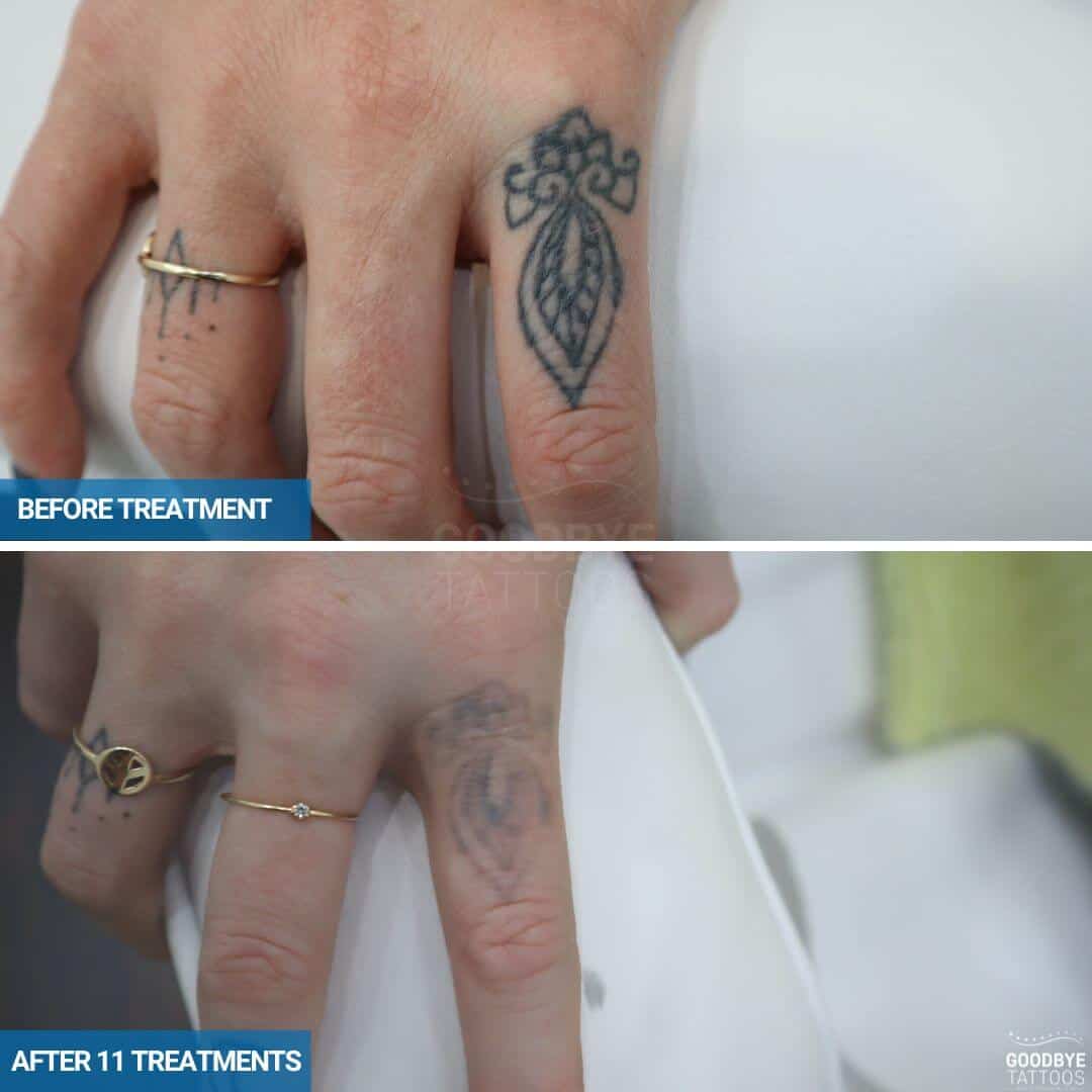 Laser tattoo removal of a black ink tattoo on a finger