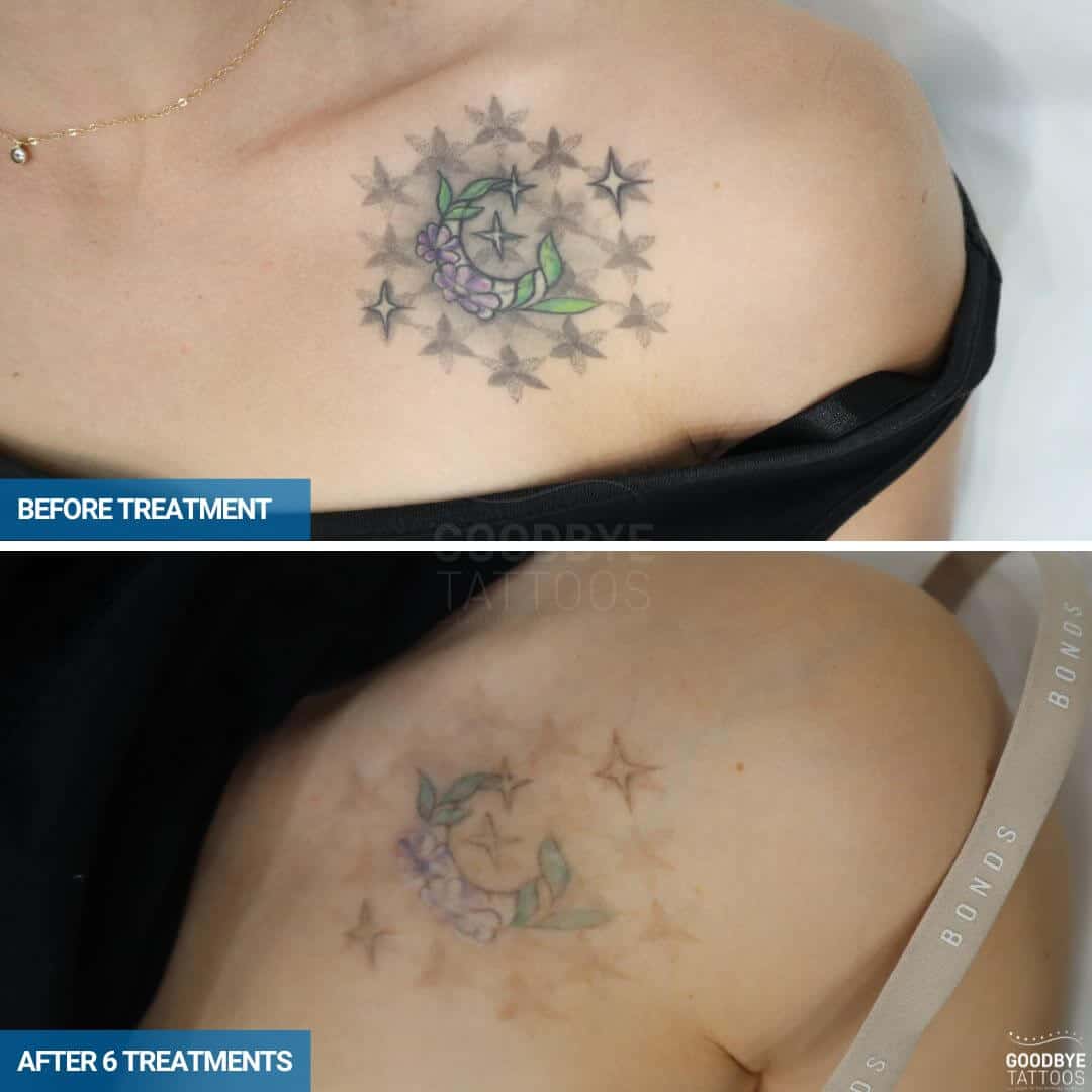 Laser tattoo removal of a flowers and stars tattoo in black, green, and purple.