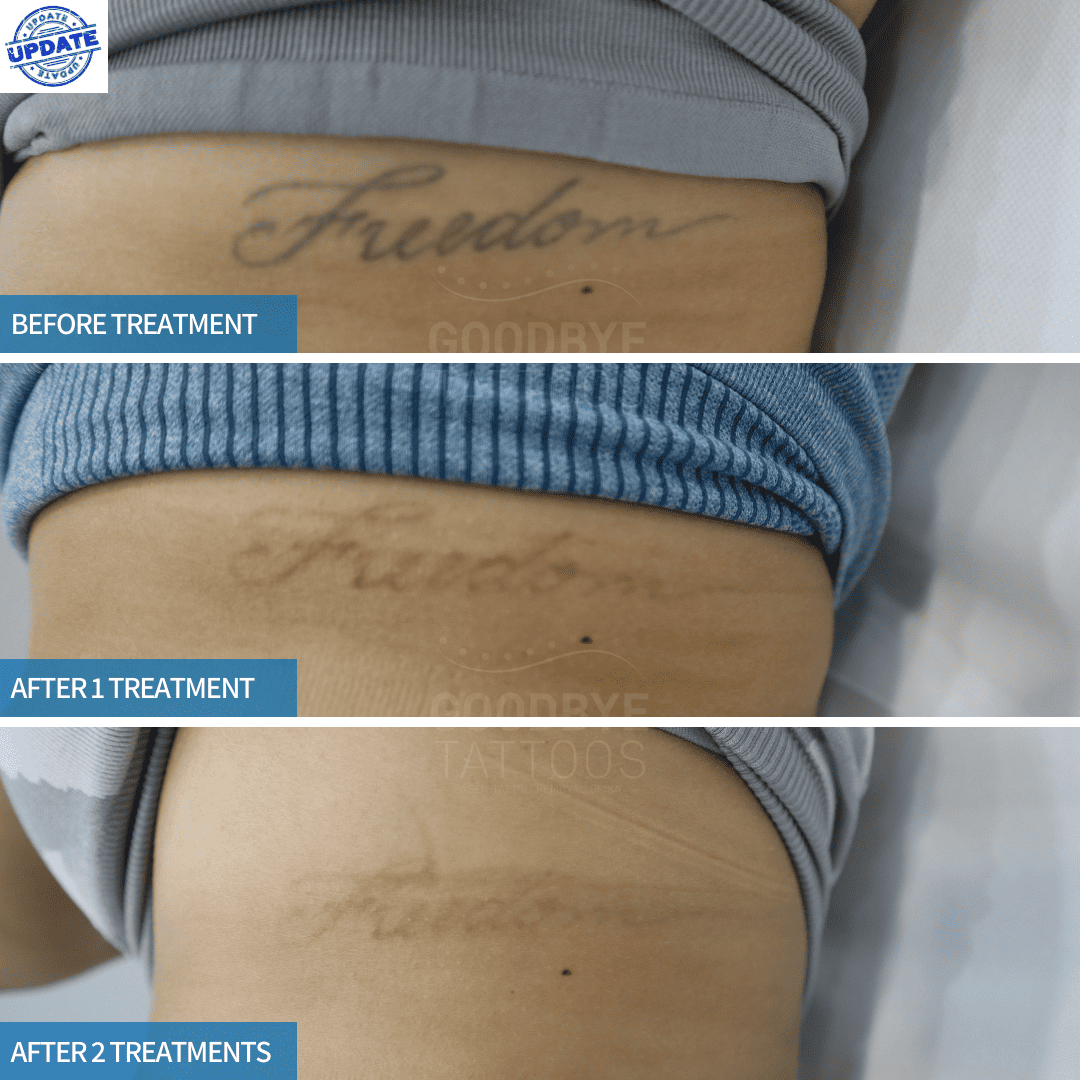 Before and after images of laser tattoo removal on a "Freedom" tattoo, showing fading after two treatments.