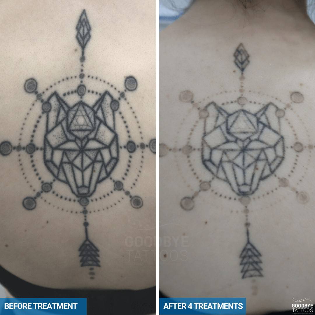 Laser tattoo removal progress photo of a black back tattoo Aztec maze.