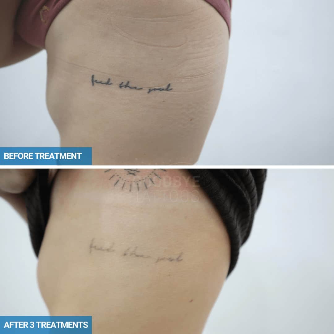 Laser tattoo removal progress photo of a black tattoo on the ribs.