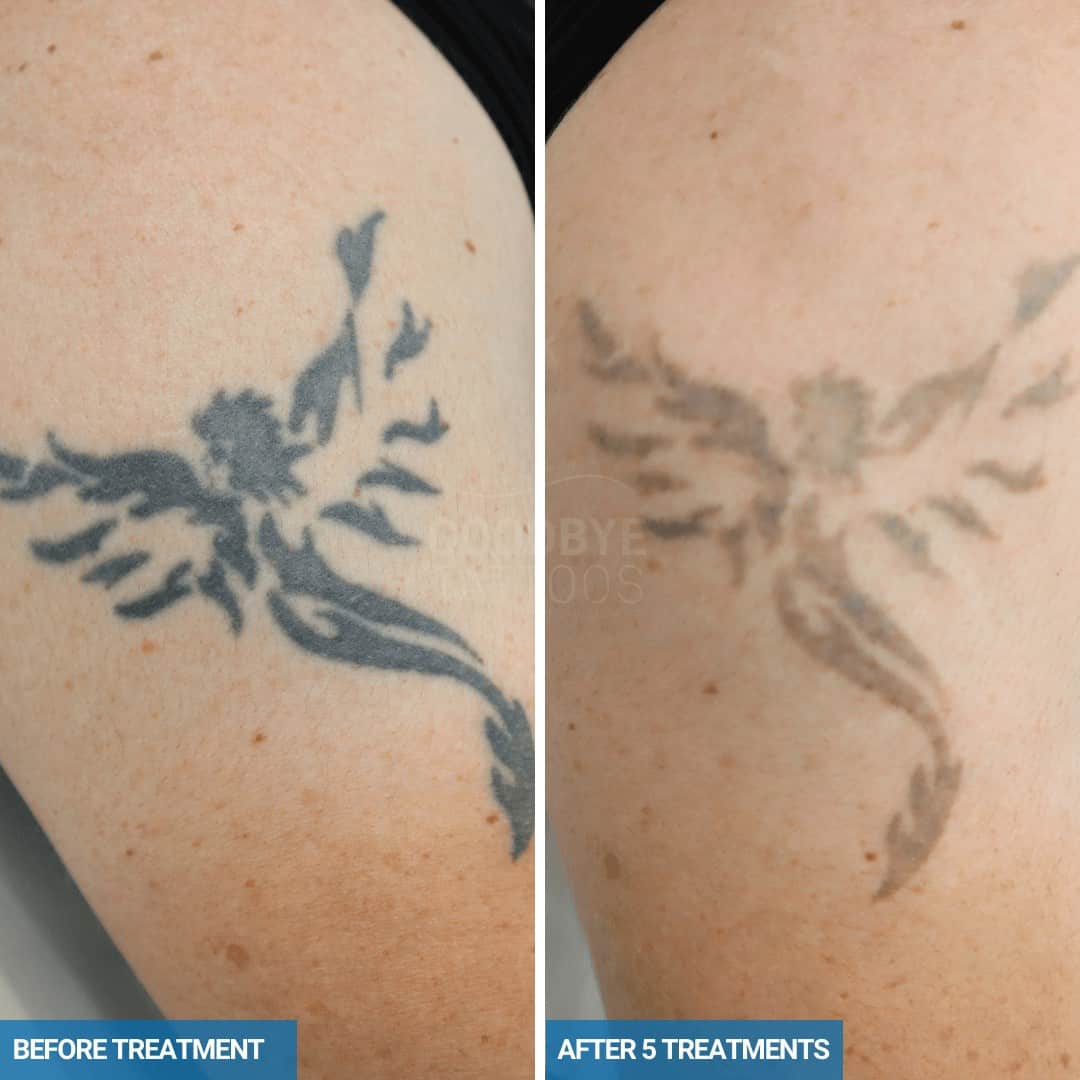 Laser tattoo removal progress photo of a black ink tattoo of a Phoenix.