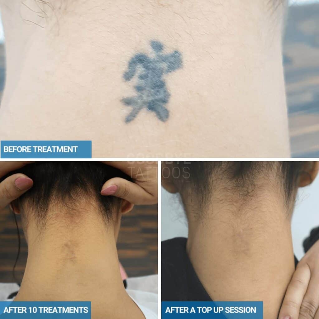 Laser tattoo removal progress photo of Chinese writing on the back of the neck.