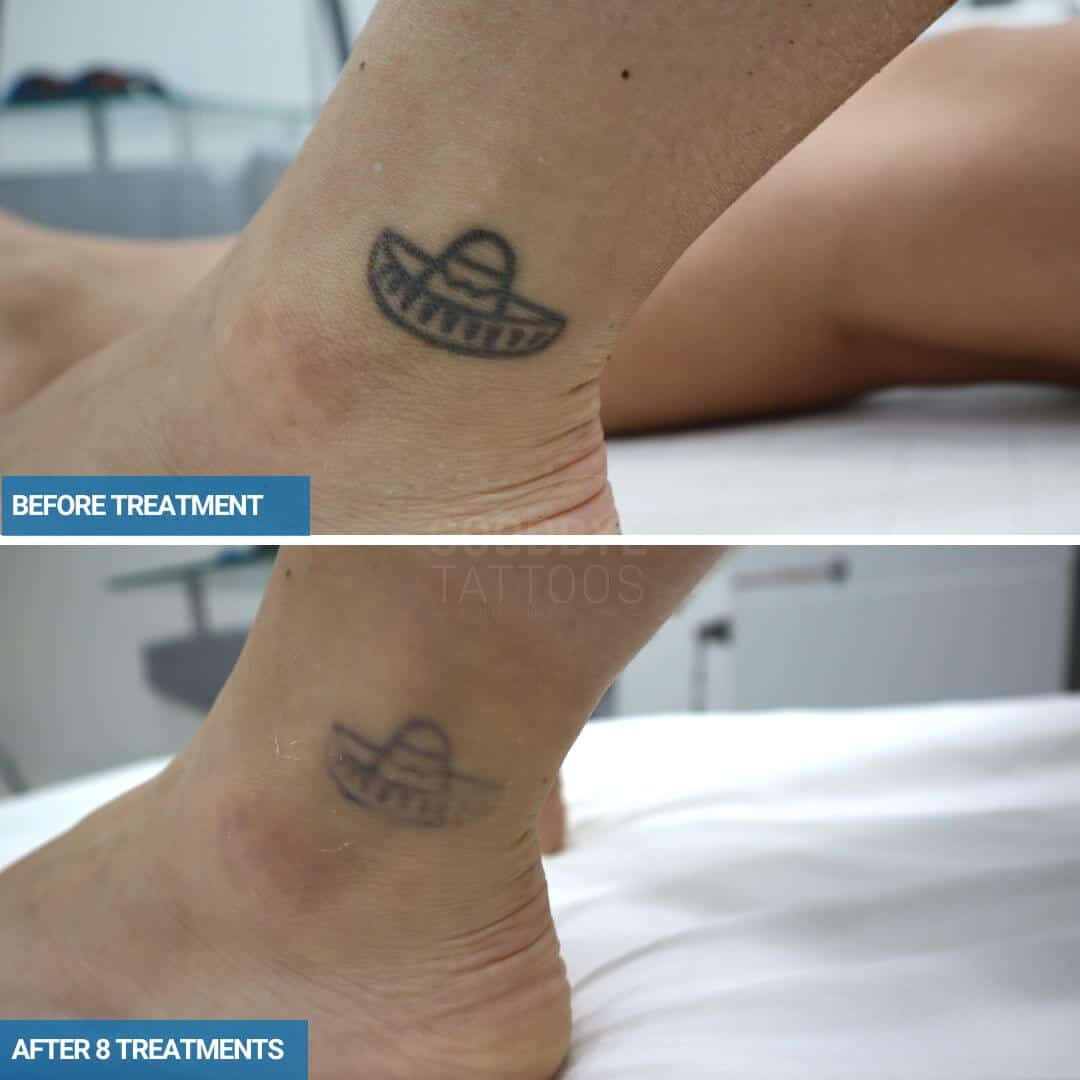 Laser tattoo removal progress photo of a black ink Sombrero on an ankle