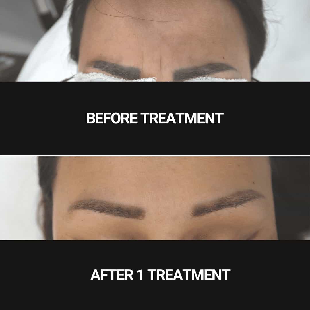 Before and after comparison of eyebrow tattoo removal showing progress after one treatment.