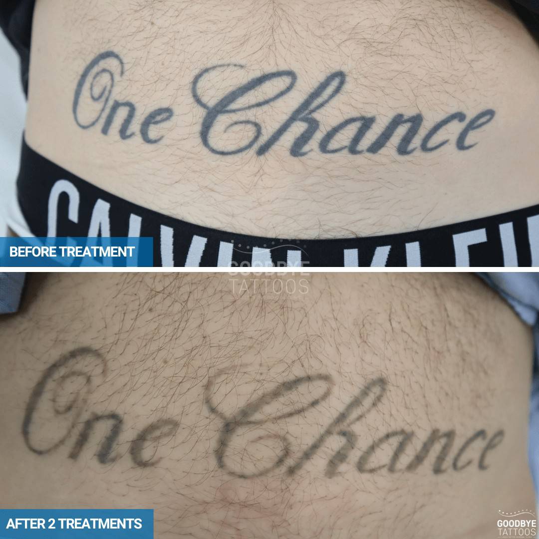 Laser tattoo removal progress of a black ink tattoo on the stomach reading One Chance.