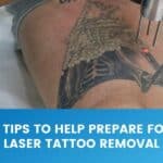 Image showing a laser tattoo removal treatment with the words 8 tips to help prepare for laser tattoo removal