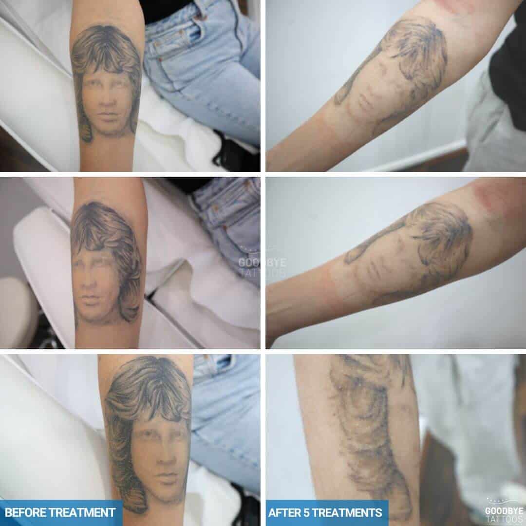 Laser tattoo removal progress photo of a black ink tattoo of a Jim Morrison portrait