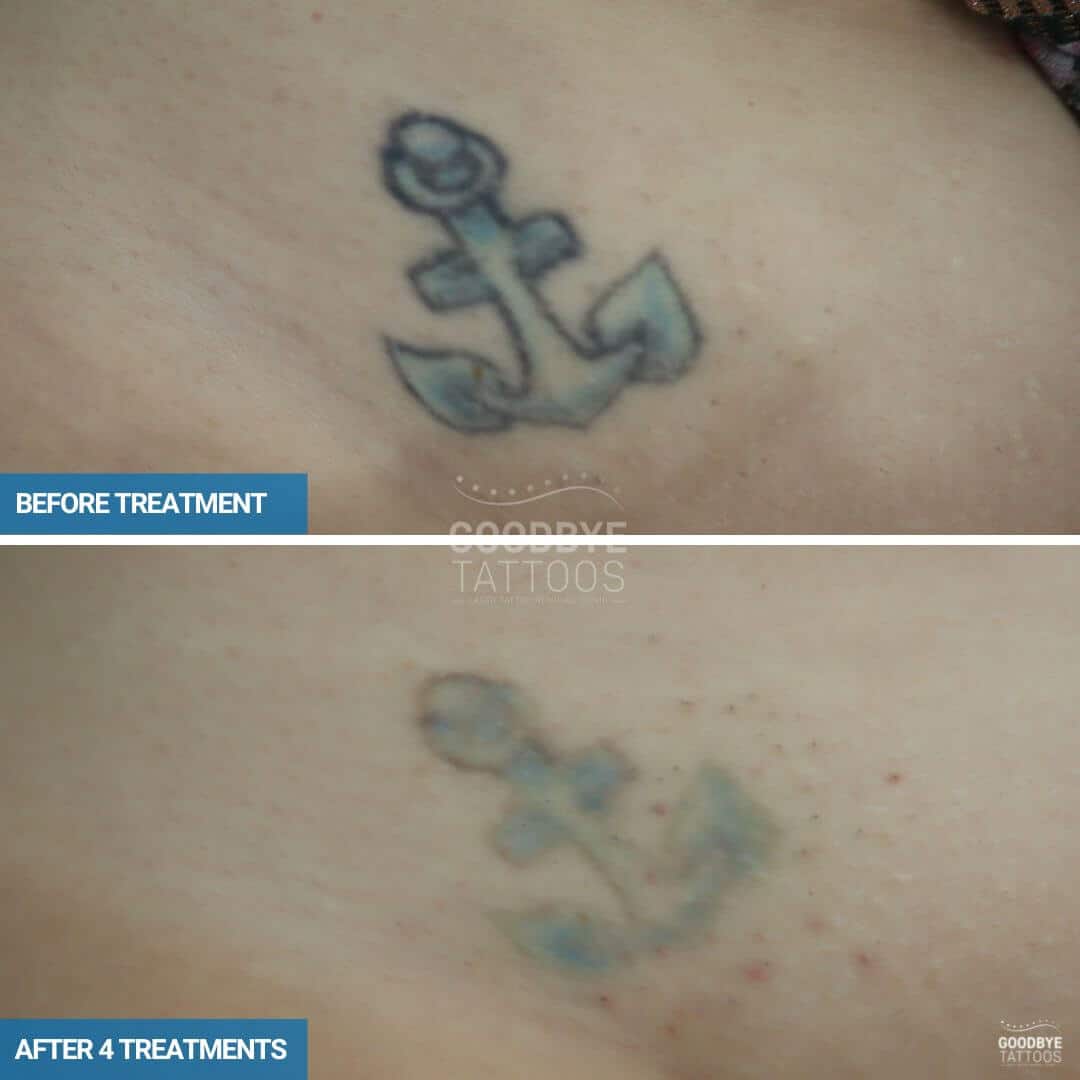 Laser Tattoo Removal progress photo of a anchor tattoo in blue and black ink