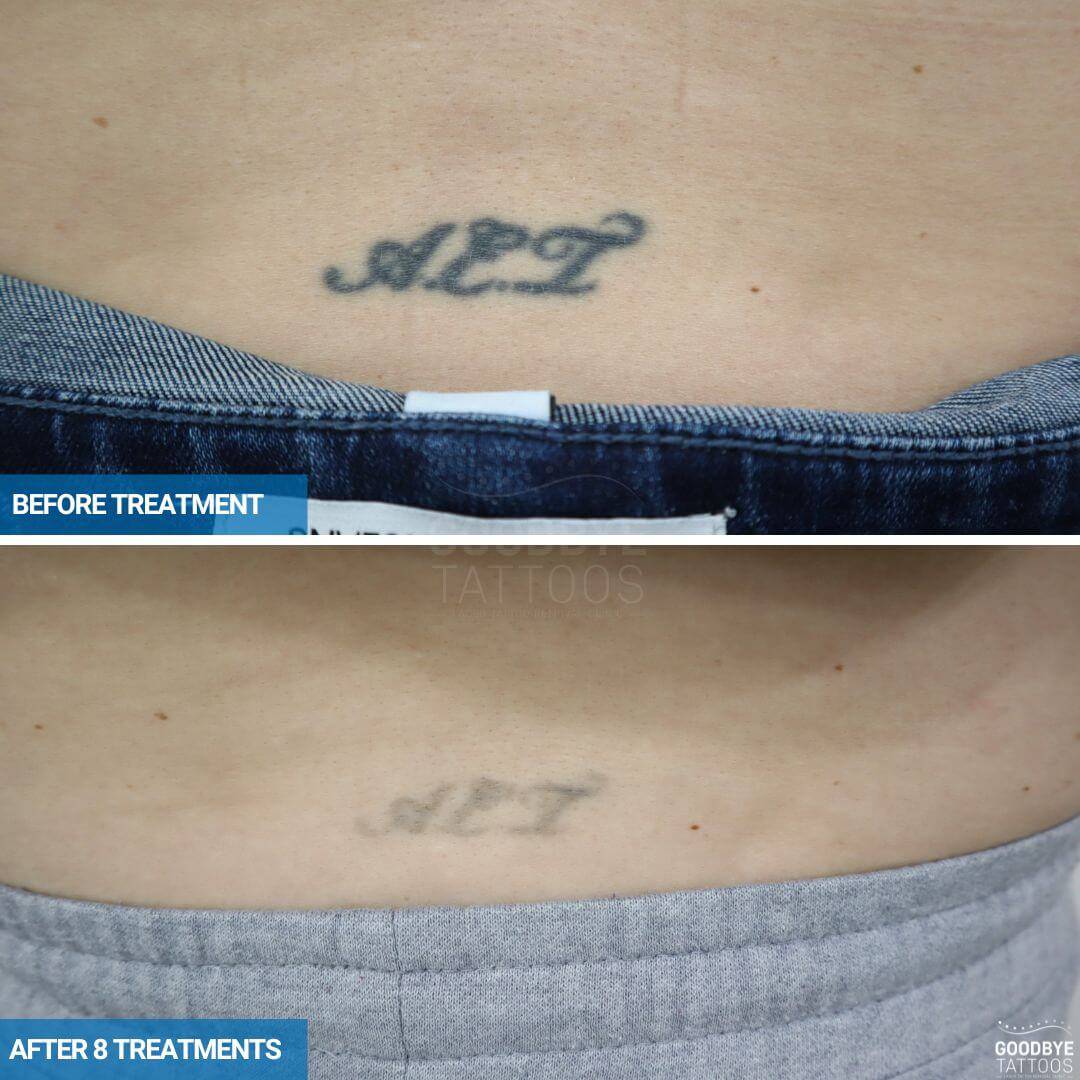 Laser tattoo removal progress photos of 3 initials in black ink on the lower back A E I