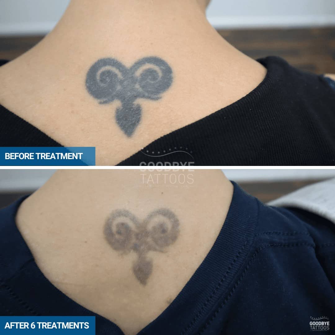 Tattoo removal progress photo of a black ink tattoo on the back of the neck.