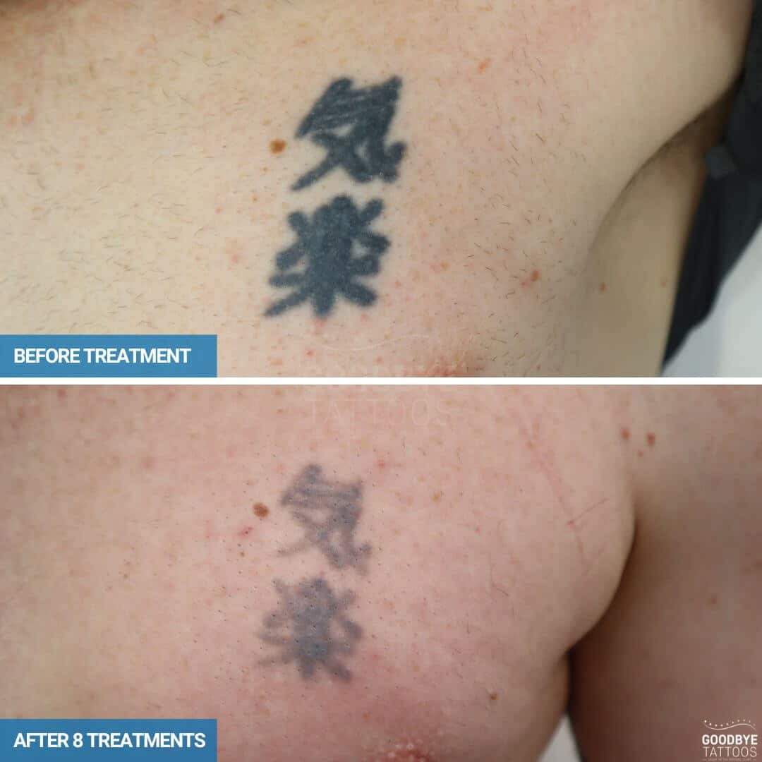 Laser tattoo removal of Chinese symbols in black ink on chest-v2
