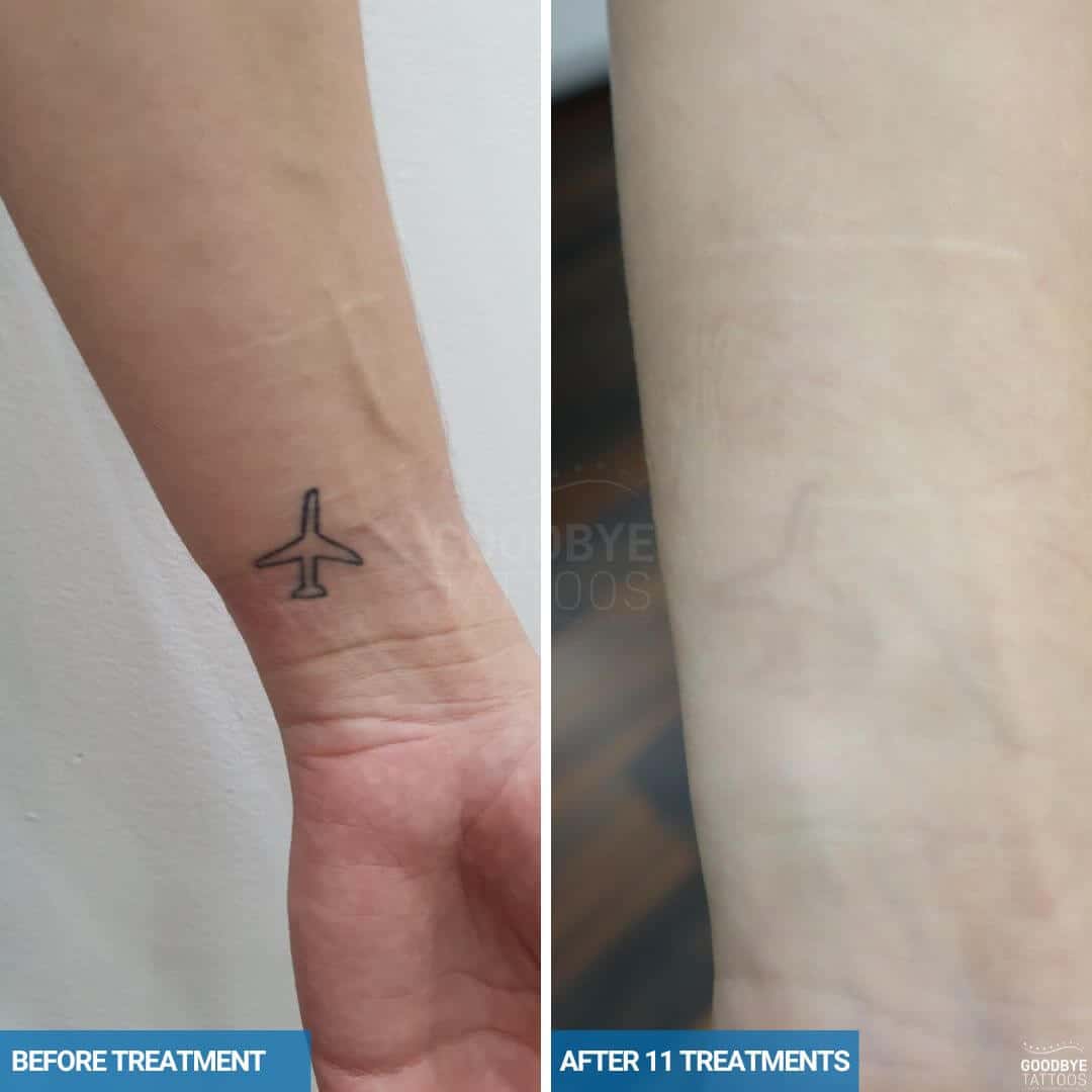 Laser tattoo removal on wrist of a black ink tattoo of an airplane