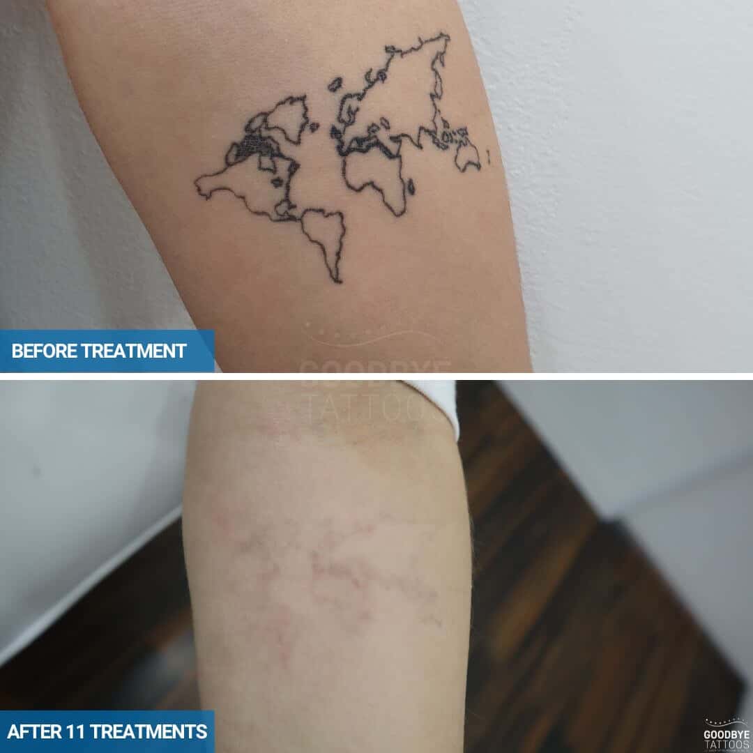 Laser tattoo removal progress of a world Atlas outline in black ink on upper arm