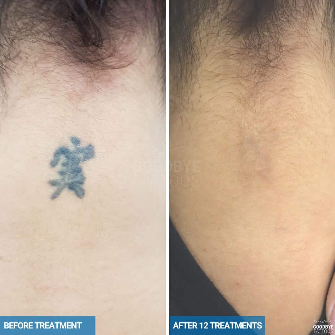 Laser tattoo removal progress photo back of neck Chinese writing in black ink
