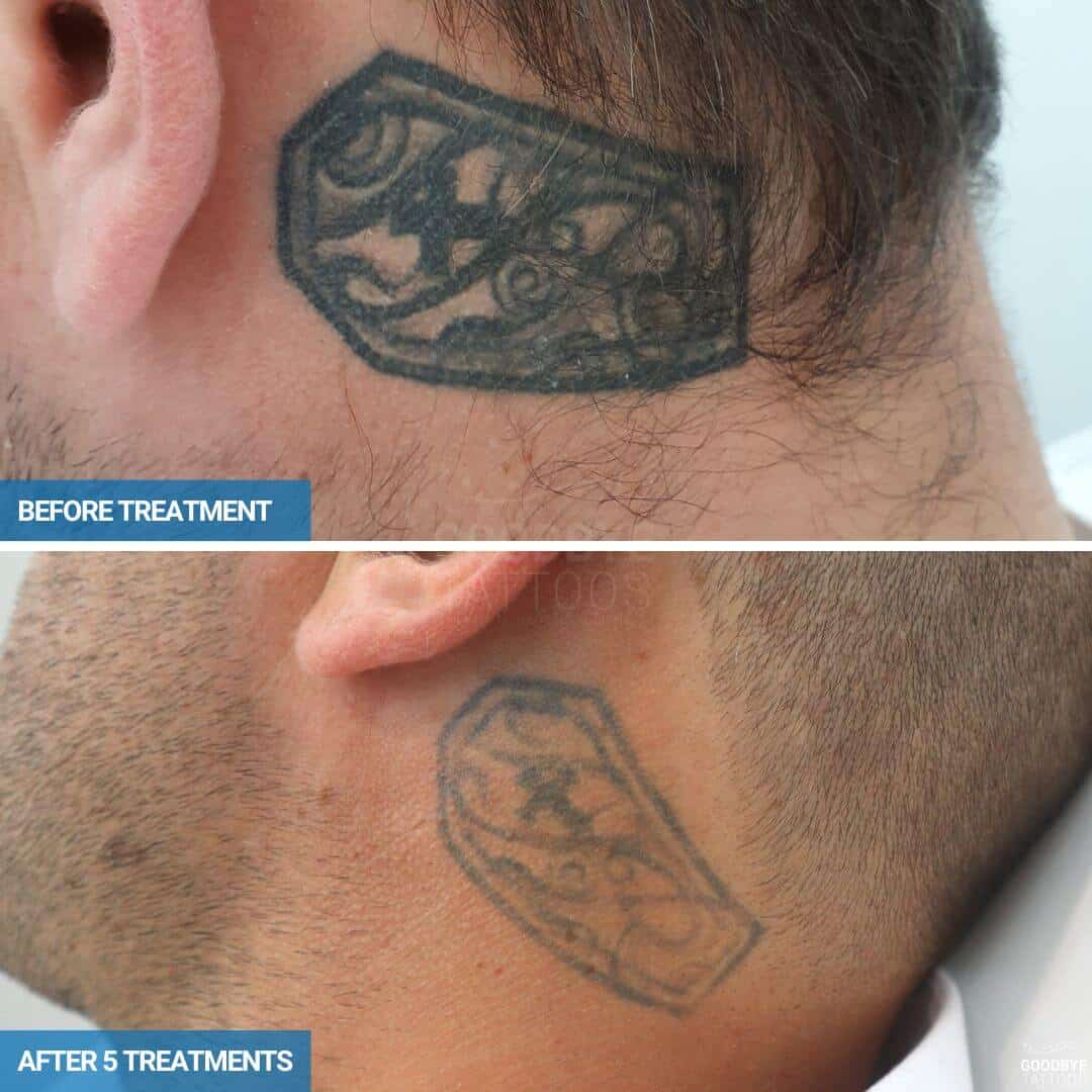 Laser tattoo removal progress photo black ink neck tattoo