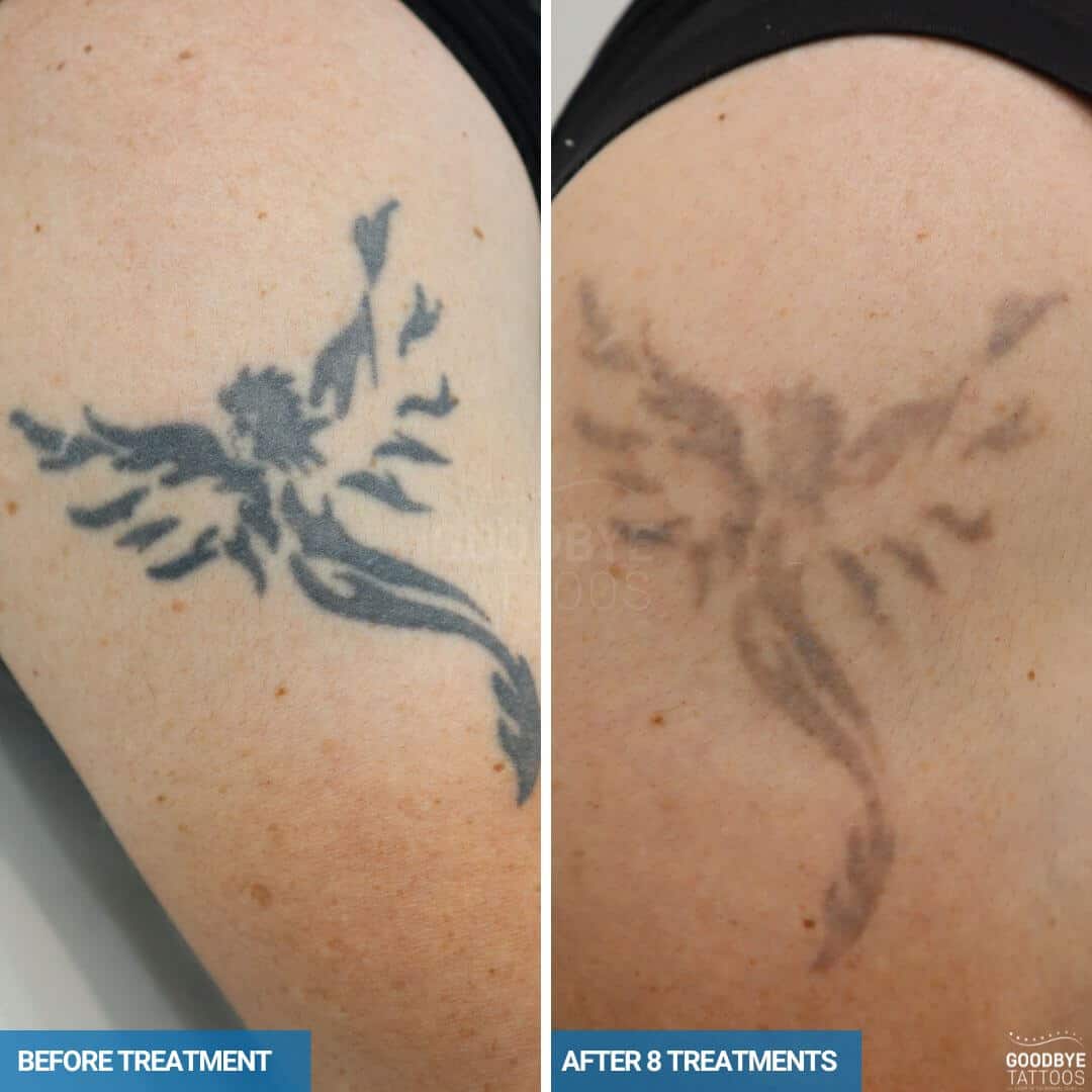 Laser tattoo removal progress photo of a black ink tattoo of a Phoenix