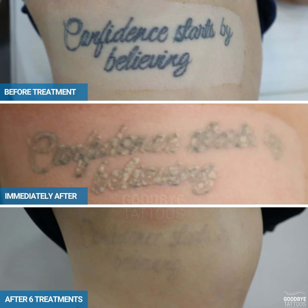 Laser tattoo removal progress photo of a black ink tattoo Confidence starts by believing