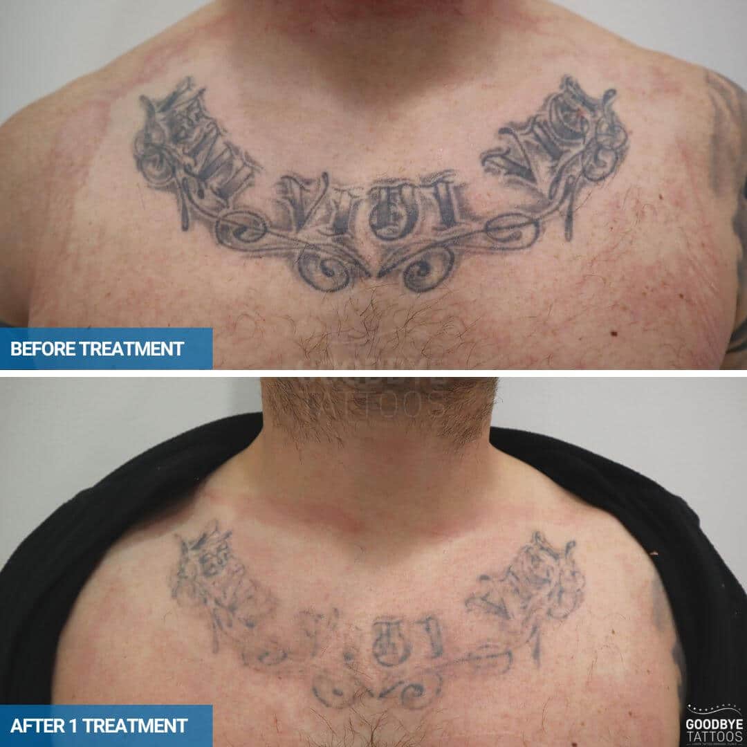 Tattoo Removal Before and After Photos | Goodbye Tattoos