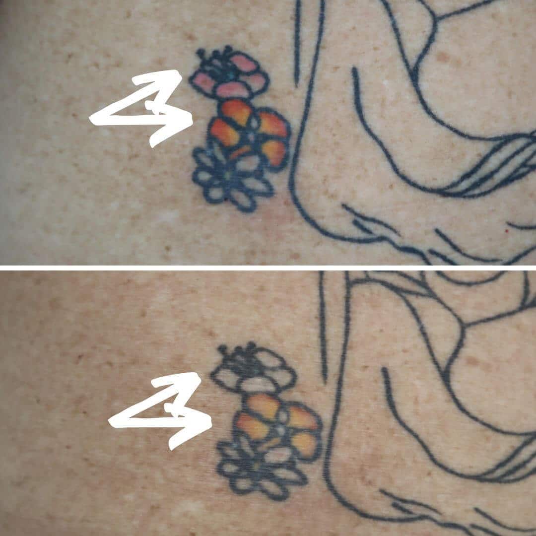 Laser tattoo removal progress photo of a multi coloured rose in red, pink, red and black