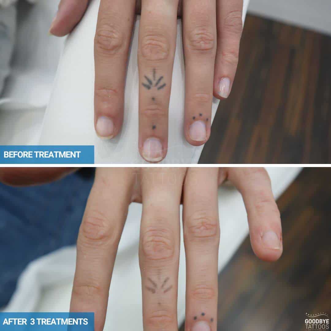 Laser tattoo removal of a black ink tattoo on the fingers of lines and dots