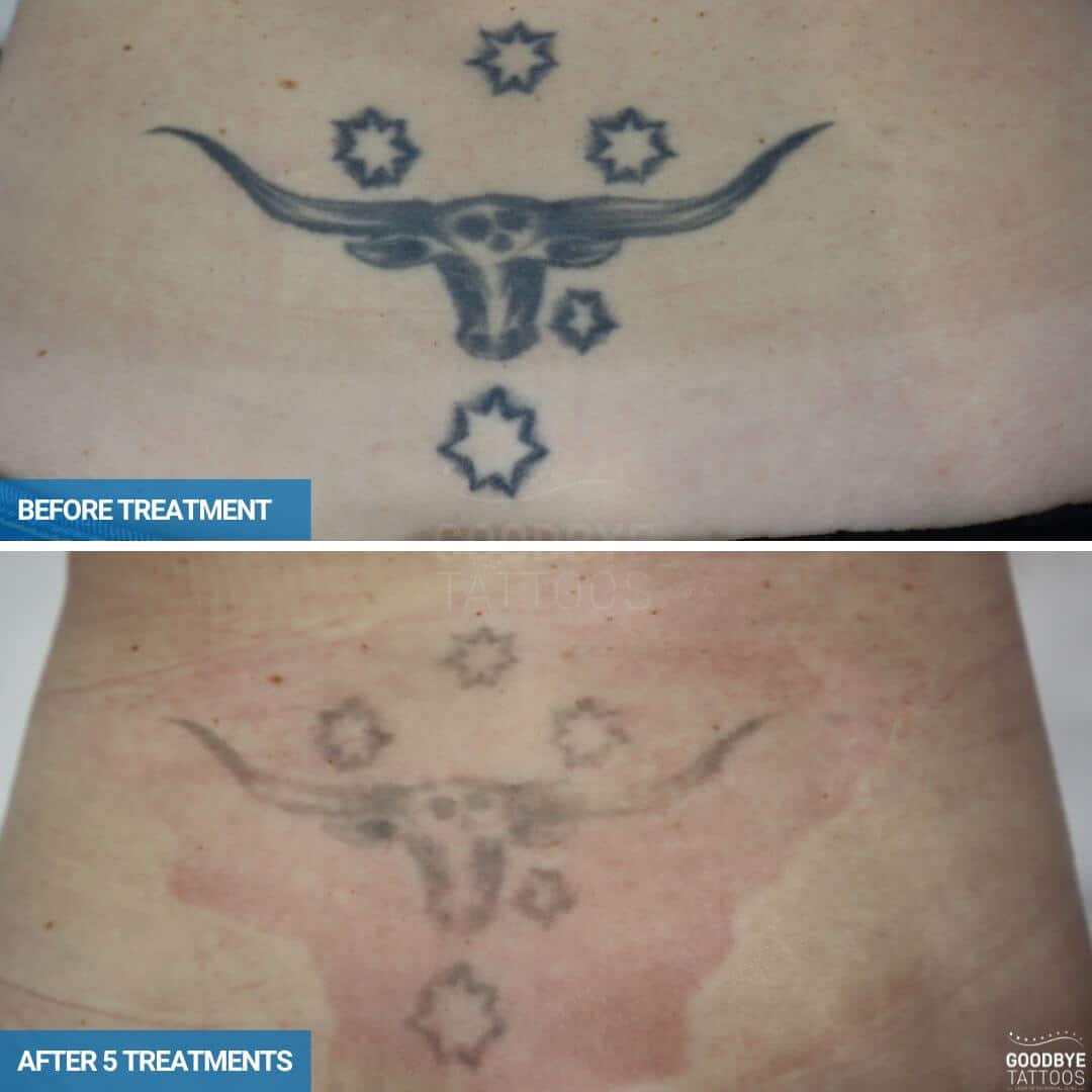 Laser tattoo removal of a bull and stars in black ink on lower back