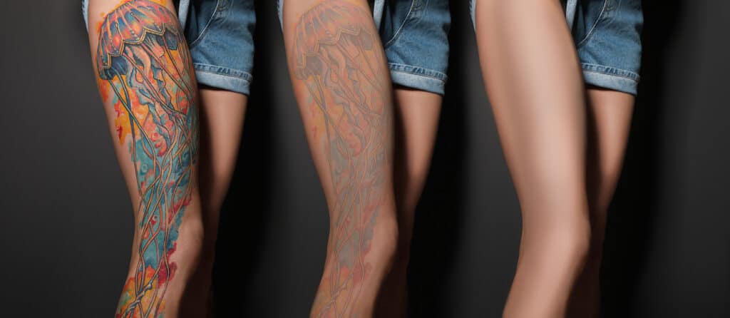Stock image showing tattoo removal progress on a woman's leg, with three stages of tattoo fading after laser treatment.