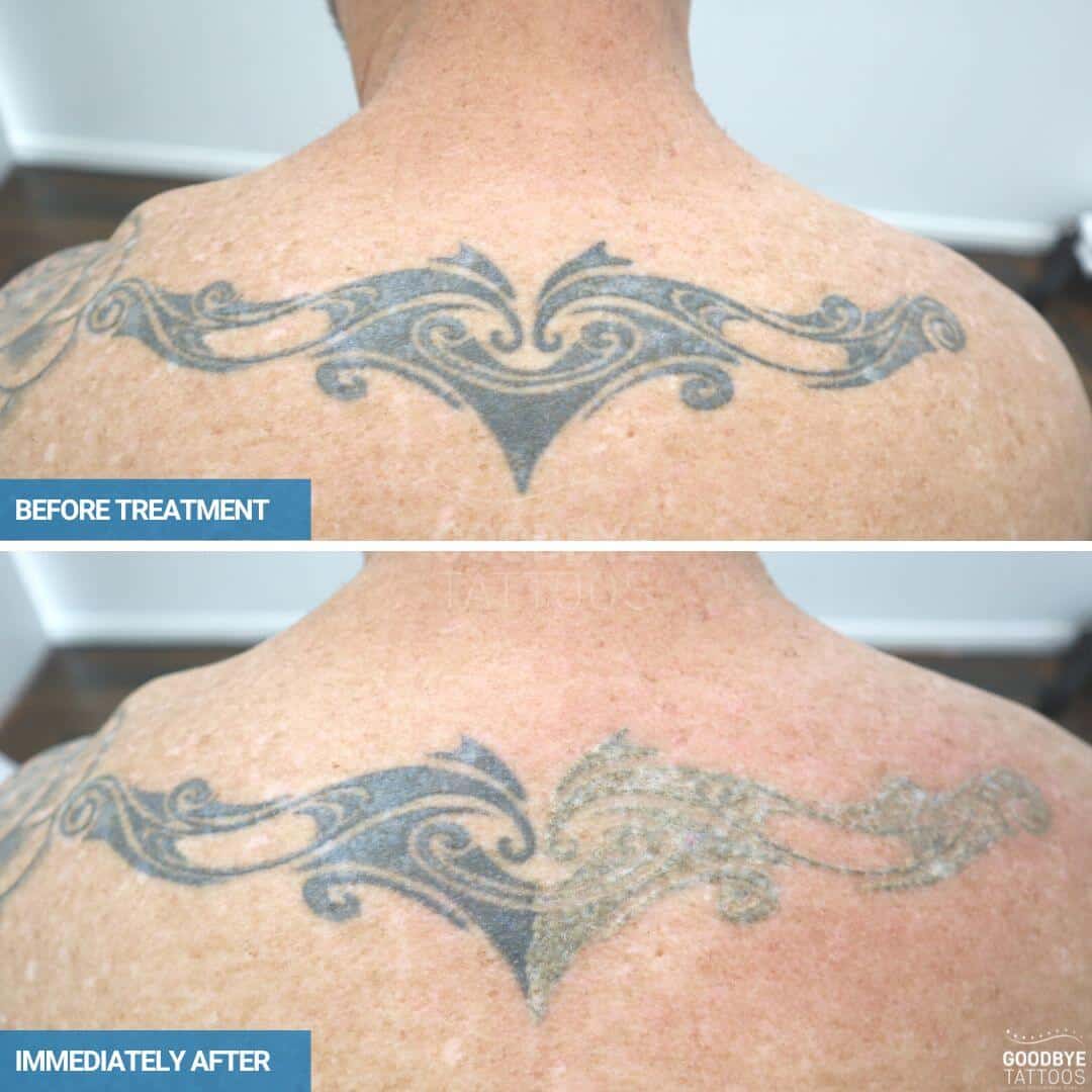 Laser tattoo removal of a large back tattoo ink black ink with half treated with laser and showing the frosting