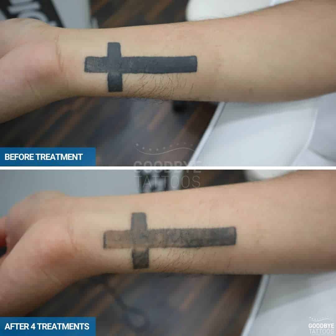 Laser tattoo removal progress photo of a cross on a wrist