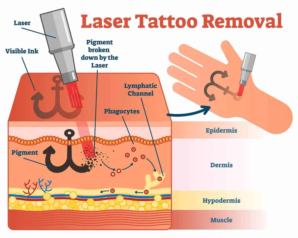 Laser tattoo removal vector illustration diagram showing the laser breaking down the ink in the skin