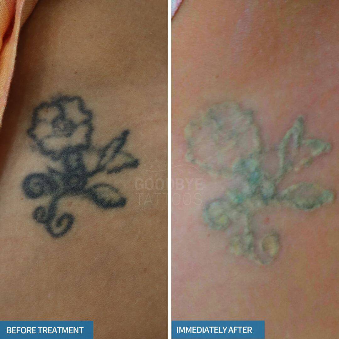 Laser tattoo removal frosting photo of a black ink tattoo of a rose