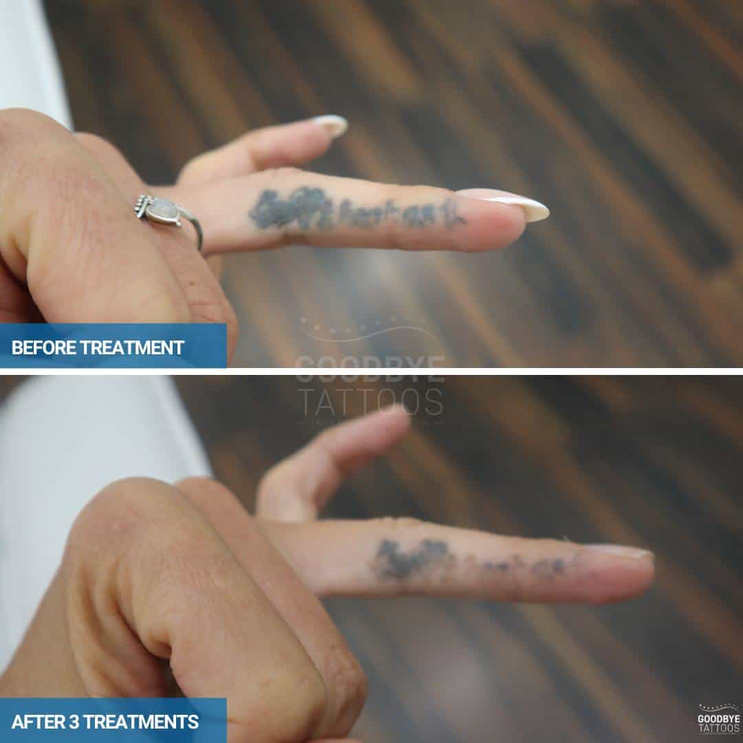 Before and after image of a finger tattoo removal process showing results after three treatments, highlighting progressive fading.