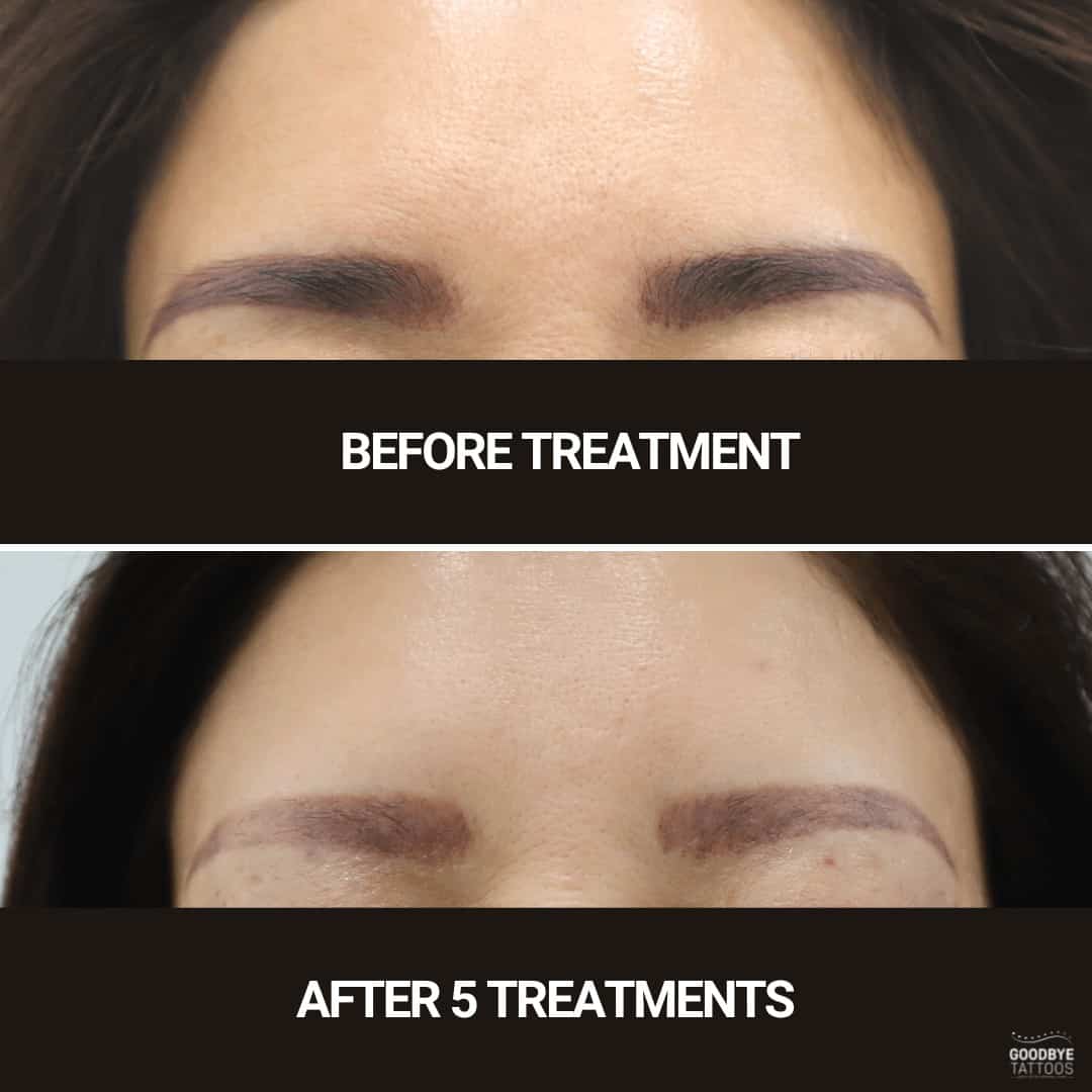 Before and after images of eyebrow tattoo removal showing progressive fading over five treatments, highlighting laser effectiveness.