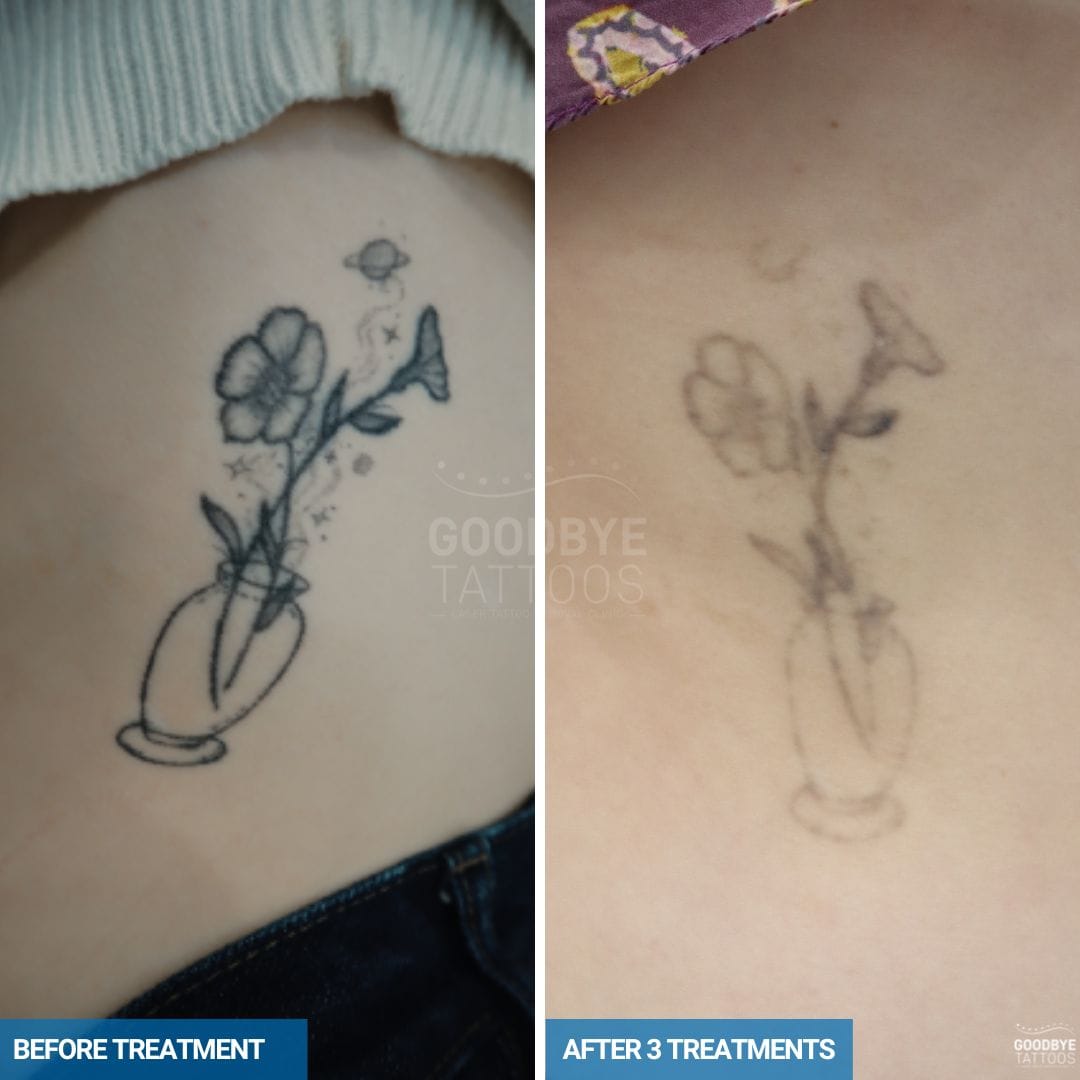 Laser tattoo removal of flowers in a vase in black ink