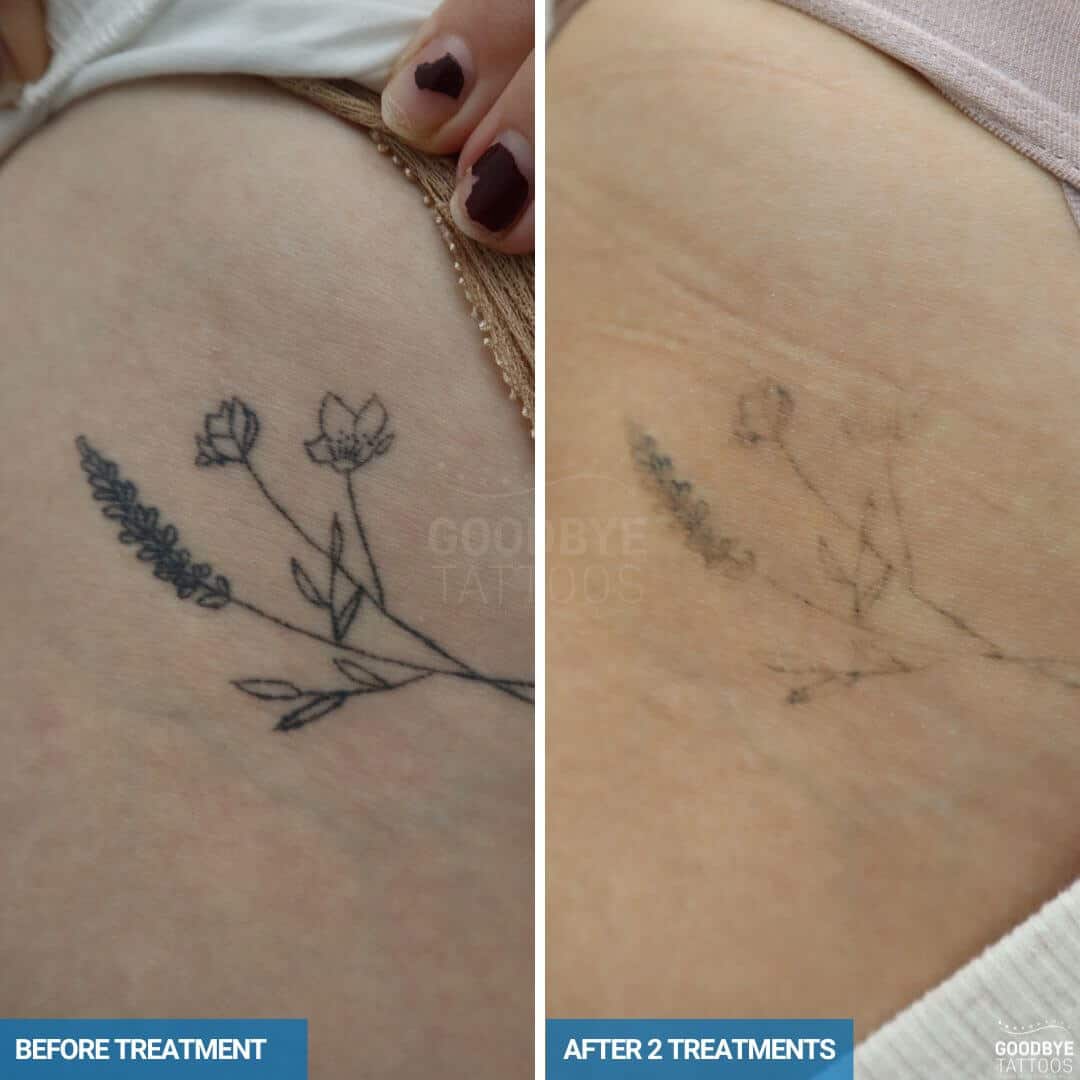 Before and after images showing laser tattoo removal progress for a black rose and petals tattoo after two treatments.