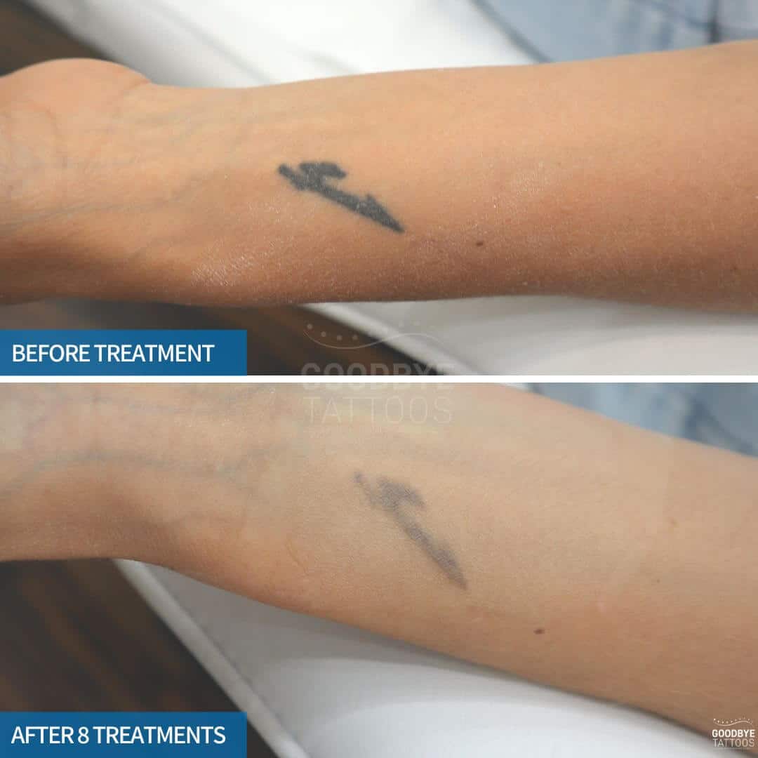 Laser tattoo removal progress photoof a blank ink tattoo on the wrist